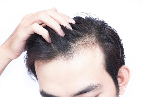 Hairloss-treatment